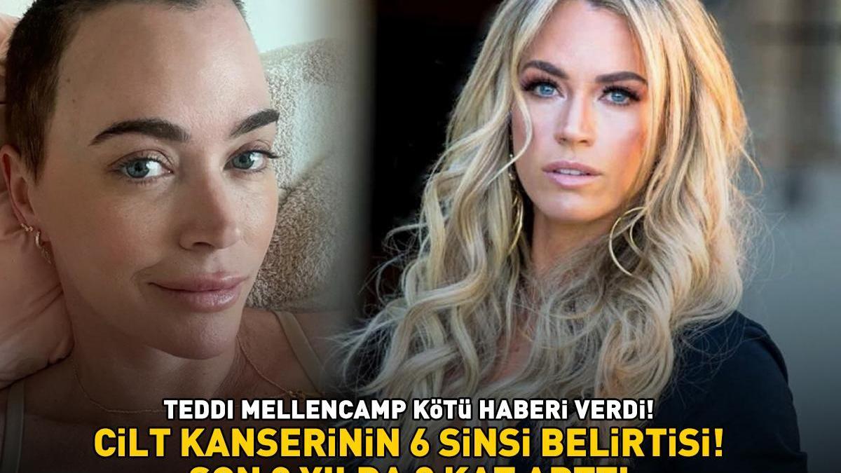 Real Housewives of Beverly Hills’in yıldızı Teddi Mellencamp’ten kötü haber! Aman dikkat! İşte cilt kanserinin 6 sinsi belirtisi…